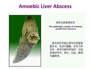 Amoebic Liver Abscess
 