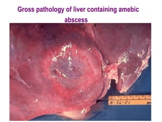 Gross pathology of liver containing amebic
               abscess
 