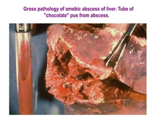 Gross pathology of amebic abscess of liver. Tube of
         "chocolate" pus from abscess. 
 