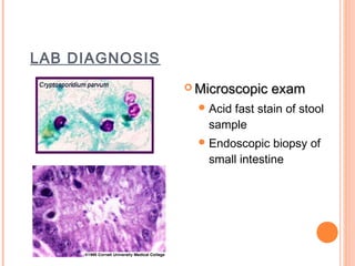 LAB DIAGNOSIS
                 Microscopic    exam
                   Acid
                       fast stain of stool
                   sample
                   Endoscopic  biopsy of
                   small intestine
 
