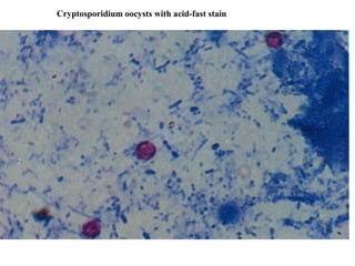 Cryptosporidium oocysts with acid-fast stain
 