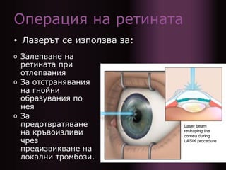 Операция на ретината
• Лазерът се използва за:
o Залепване на
ретината при
отлепвания
o За отстранявания
на гнойни
образувания по
нея
o За
предотвратяване
на кръвоизливи
чрез
предизвикване на
локални тромбози.
 