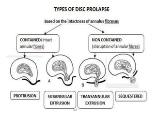 Prolapsed intervertebral disc | PPTX