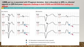 Learning Lbbb DOSE NEW LBBB MEANS STEMI(paelstine hospital ).pptx