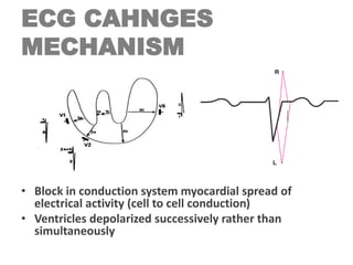 ECG CAHNGES
MECHANISM
• Block in conduction system myocardial spread of
electrical activity (cell to cell conduction)
• Ventricles depolarized successively rather than
simultaneously
 