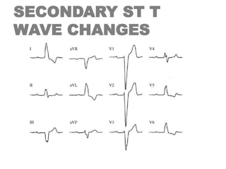 SECONDARY ST T
WAVE CHANGES
 