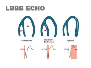 LBBB ECHO
 