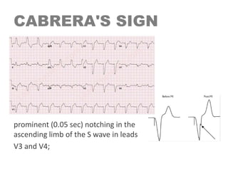 CABRERA'S SIGN
prominent (0.05 sec) notching in the
ascending limb of the S wave in leads
V3 and V4;
 