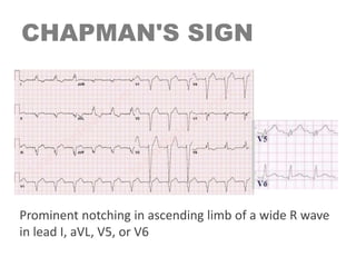 CHAPMAN'S SIGN
Prominent notching in ascending limb of a wide R wave
in lead I, aVL, V5, or V6
 