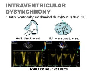 INTRAVENTRICULAR
DYSYNCHRONY
• Inter-ventricular mechanical delay(IVMD) &LV PEF
 