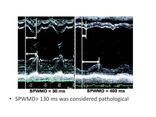 • SPWMD> 130 ms was considered pathological
 
