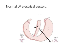 Normal LV electrical vector….
 