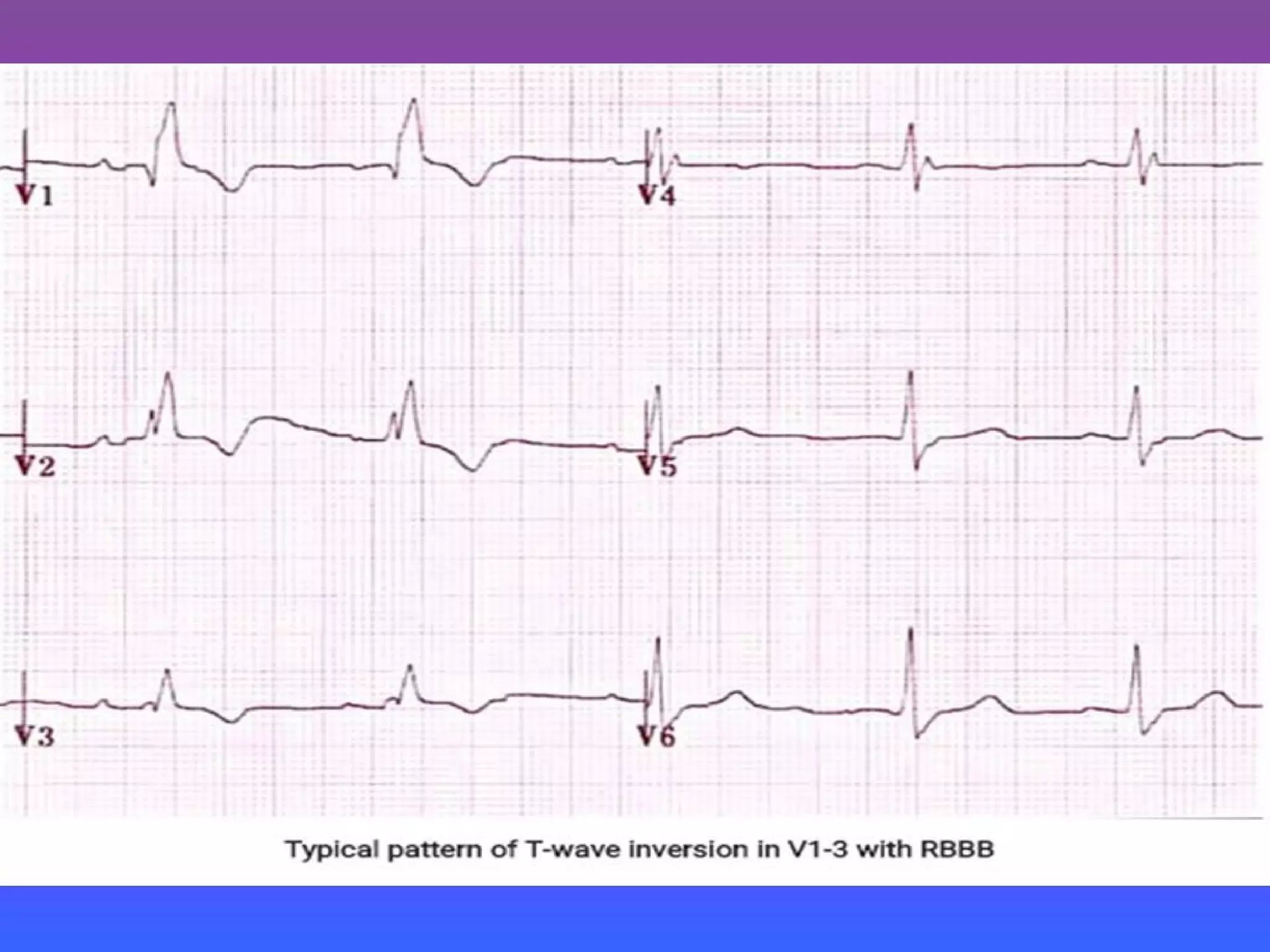 LBBB + RBBB