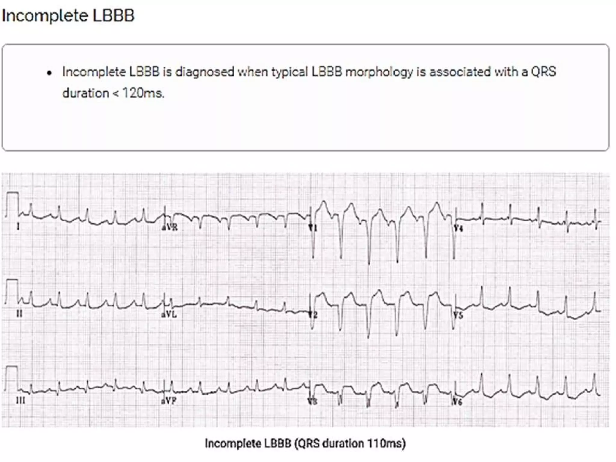 LBBB + RBBB