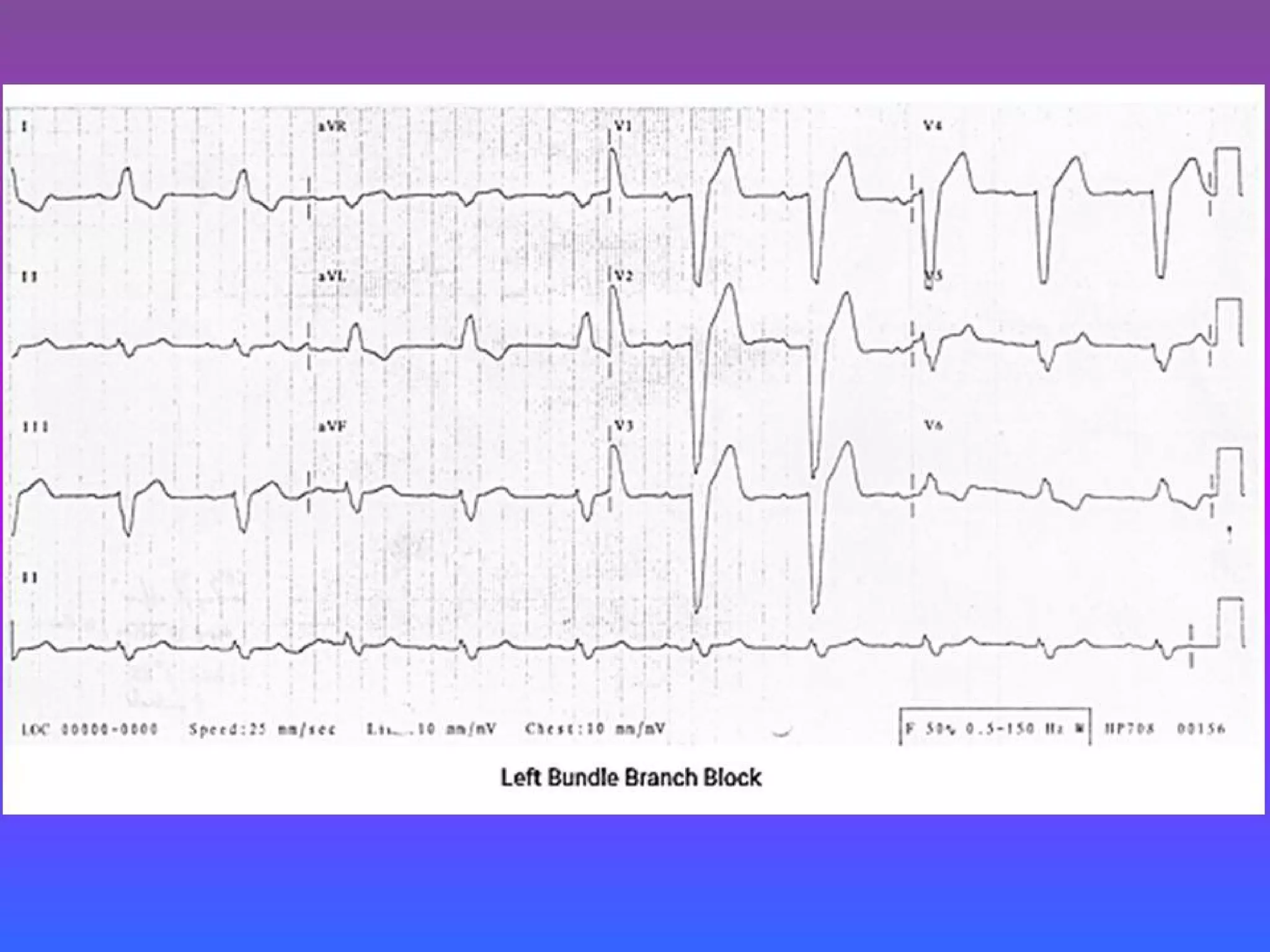 LBBB + RBBB