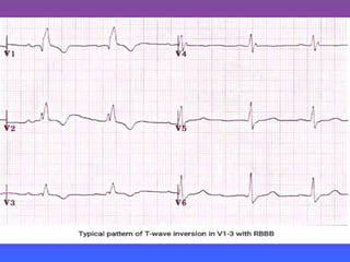 LBBB + RBBB