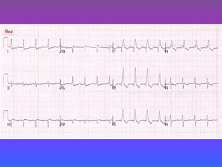 LBBB + RBBB