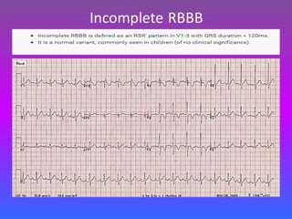 LBBB + RBBB
