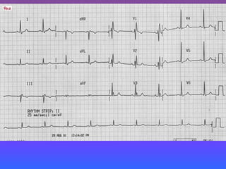 LBBB + RBBB