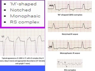 LBBB + RBBB