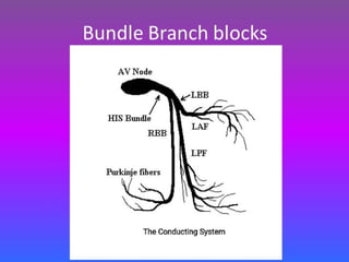 LBBB + RBBB