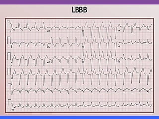 LBBB + RBBB