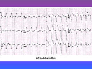 LBBB + RBBB
