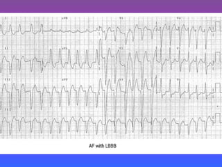 LBBB + RBBB