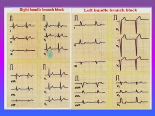 LBBB + RBBB