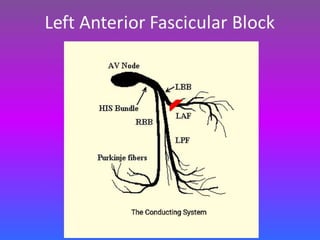 LBBB + RBBB