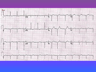 LBBB + RBBB