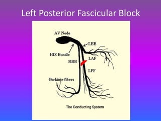 LBBB + RBBB