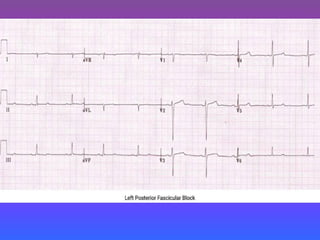 LBBB + RBBB