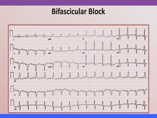 LBBB + RBBB