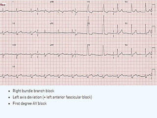 LBBB + RBBB