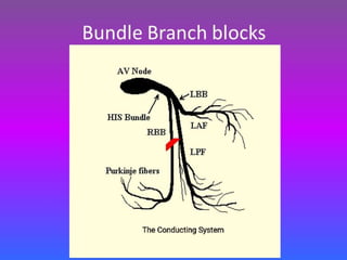 LBBB + RBBB