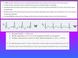 LBBB + RBBB