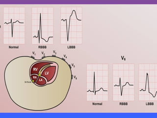 LBBB + RBBB