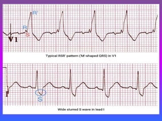 LBBB + RBBB