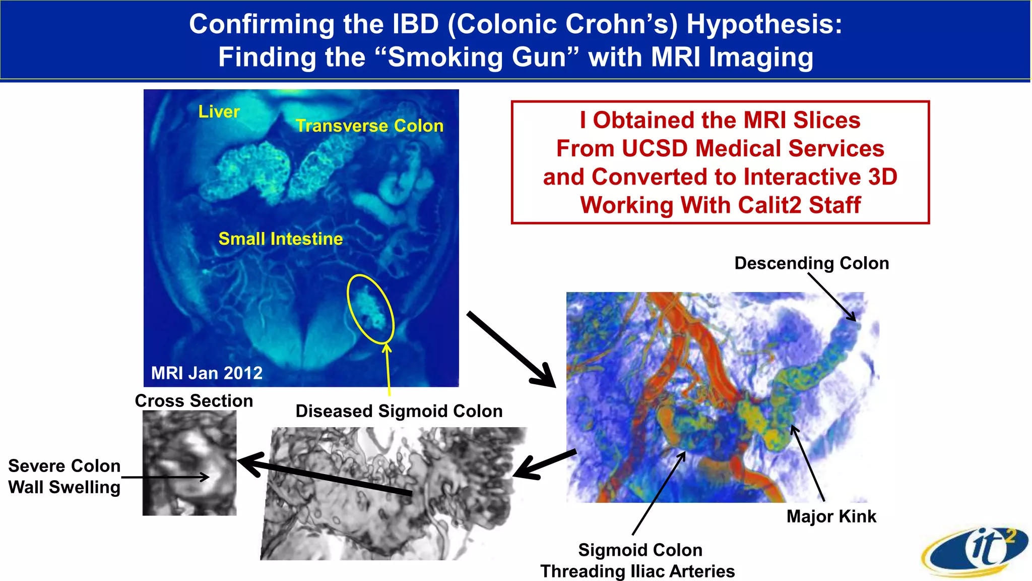 Descending Colon
Sigmoid Colon
Threading Iliac Arteries
Major Kink
Confirming the IBD (Colonic Crohn’s) Hypothesis:
Finding the “Smoking Gun” with MRI Imaging
I Obtained the MRI Slices
From UCSD Medical Services
and Converted to Interactive 3D
Working With Calit2 Staff
Transverse Colon
Liver
Small Intestine
Diseased Sigmoid Colon
Cross Section
MRI Jan 2012
Severe Colon
Wall Swelling
 