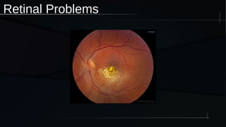 Retinal Problems
 
