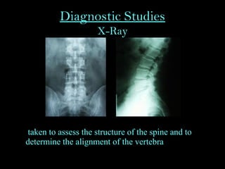 Diagnostic Studies
X-Ray
• taken to assess the structure of the spine and to
determine the alignment of the vertebra
 