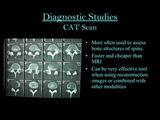 Diagnostic Studies
CAT Scan
• Most often used to assess
bone structures of spine.
• Faster and cheaper than
MRI
• Can be very effective tool
when using reconstruction
images or combined with
other modalities
 