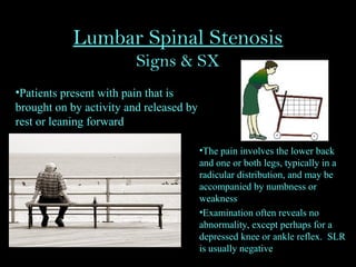 Lumbar Spinal Stenosis
Signs & SX
•Patients present with pain that is
brought on by activity and released by
rest or leaning forward
•The pain involves the lower back
and one or both legs, typically in a
radicular distribution, and may be
accompanied by numbness or
weakness
•Examination often reveals no
abnormality, except perhaps for a
depressed knee or ankle reflex. SLR
is usually negative
 
