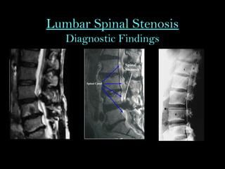 Lumbar Spinal Stenosis
Diagnostic Findings
 