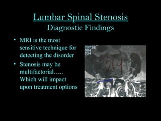 Lumbar Spinal Stenosis
Diagnostic Findings
• MRI is the most
sensitive technique for
detecting the disorder
• Stenosis may be
multifactorial…..
Which will impact
upon treatment options
 