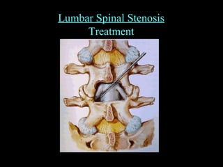Lumbar Spinal Stenosis
Treatment
 