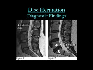 Disc Herniation
Diagnostic Findings
 