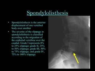Spondylolisthesis
• Spondylolisthesis is the anterior
displacement of one vertebral
body over another
• The severity of the slippage in
spondylolisthesis is classified
according to the migration of
the cephalad vertebrae over the
caudad. Grade I represents 0%
to 25% slippage; grade II, 25%
to 50% slippage; grade III, 50%
to 75% slippage; and grade IV,
75% to 100% slippage
 