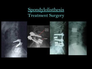 Spondylolisthesis
Treatment Surgery
 